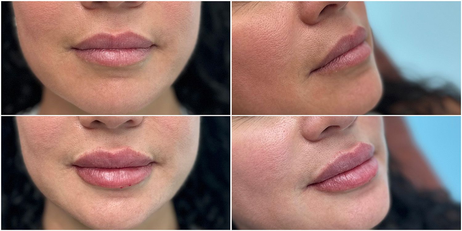 Lip Filler by Dr. Baccaro