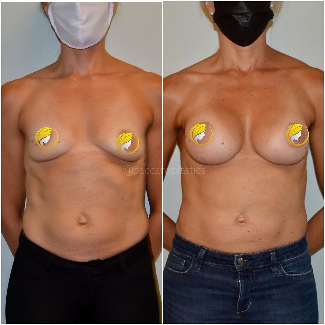 Hybrid Breast Augmentation by Dr. Baccaro