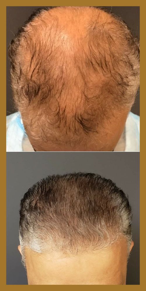 receding hairline hair restoration before and after patient