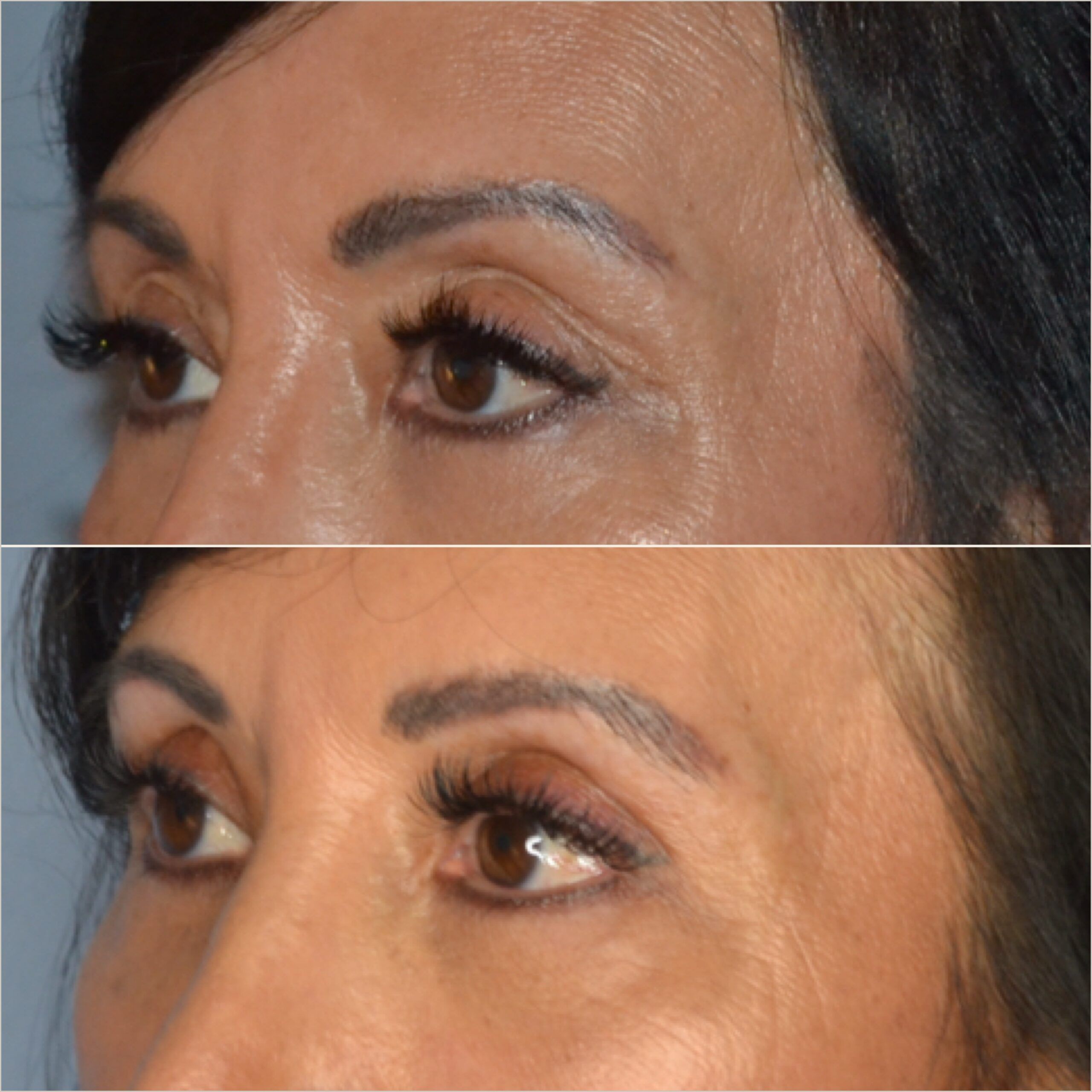 Upper Blepharoplasty by Dr. Baccaro