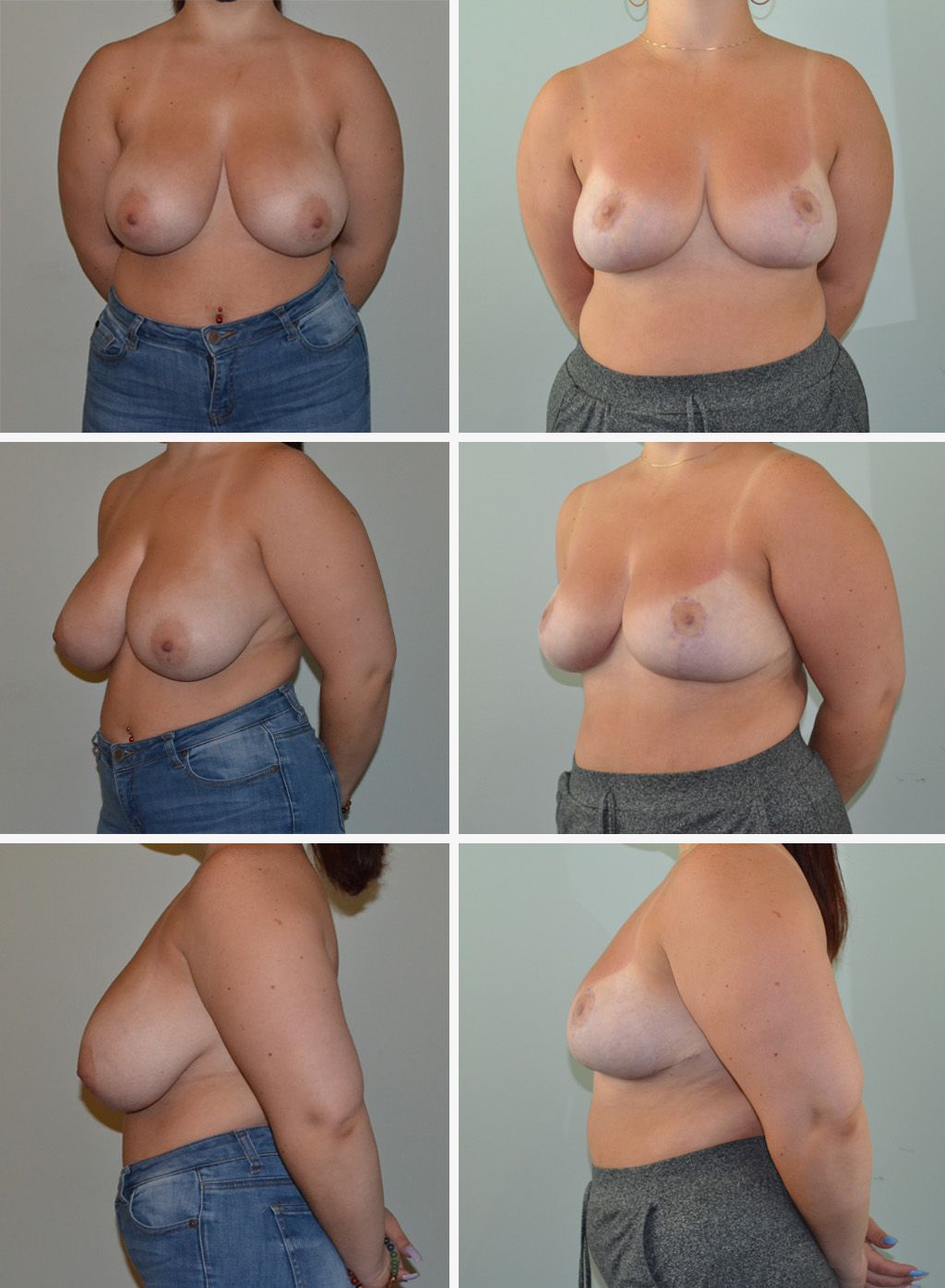 Breast Reduction Performed by Dr. Baccaro