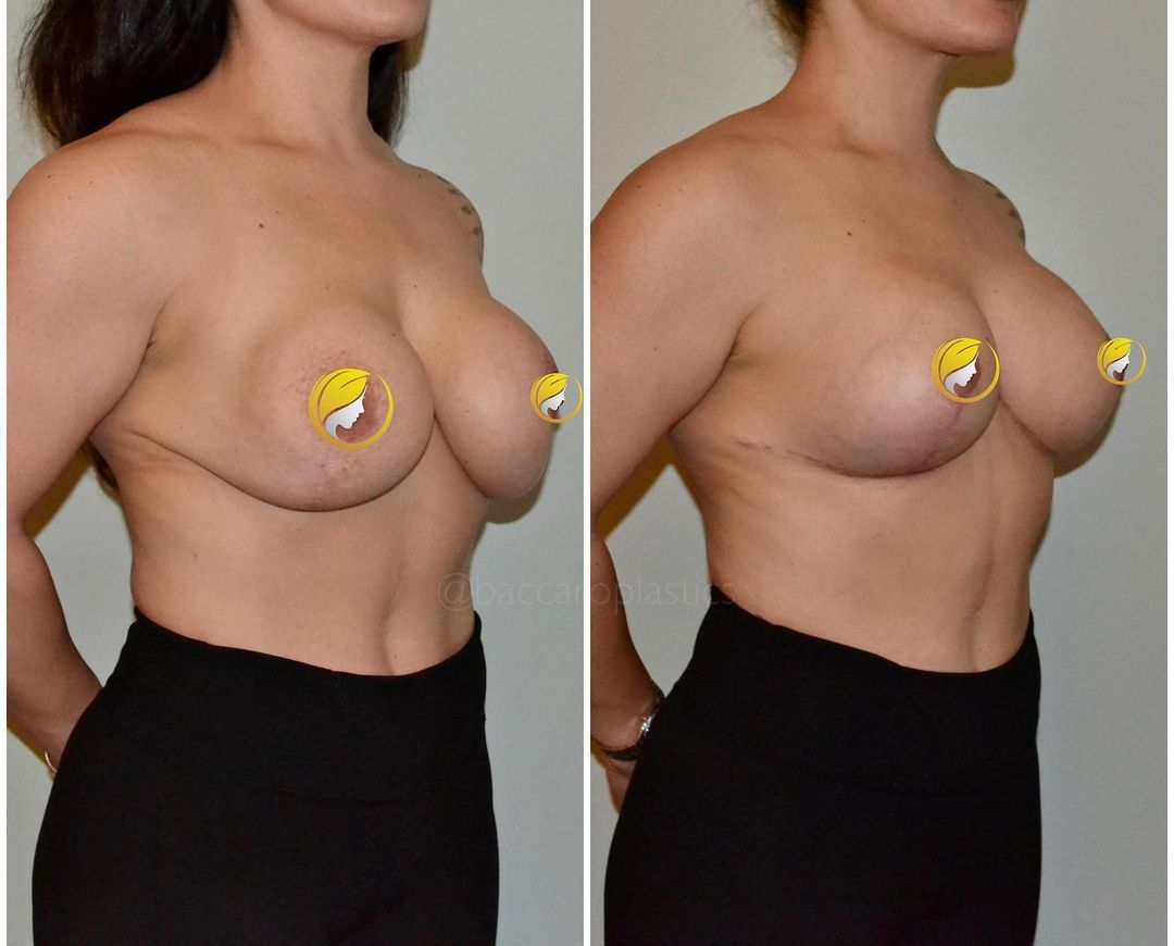 Complex Breast Revision by Dr. Baccaro