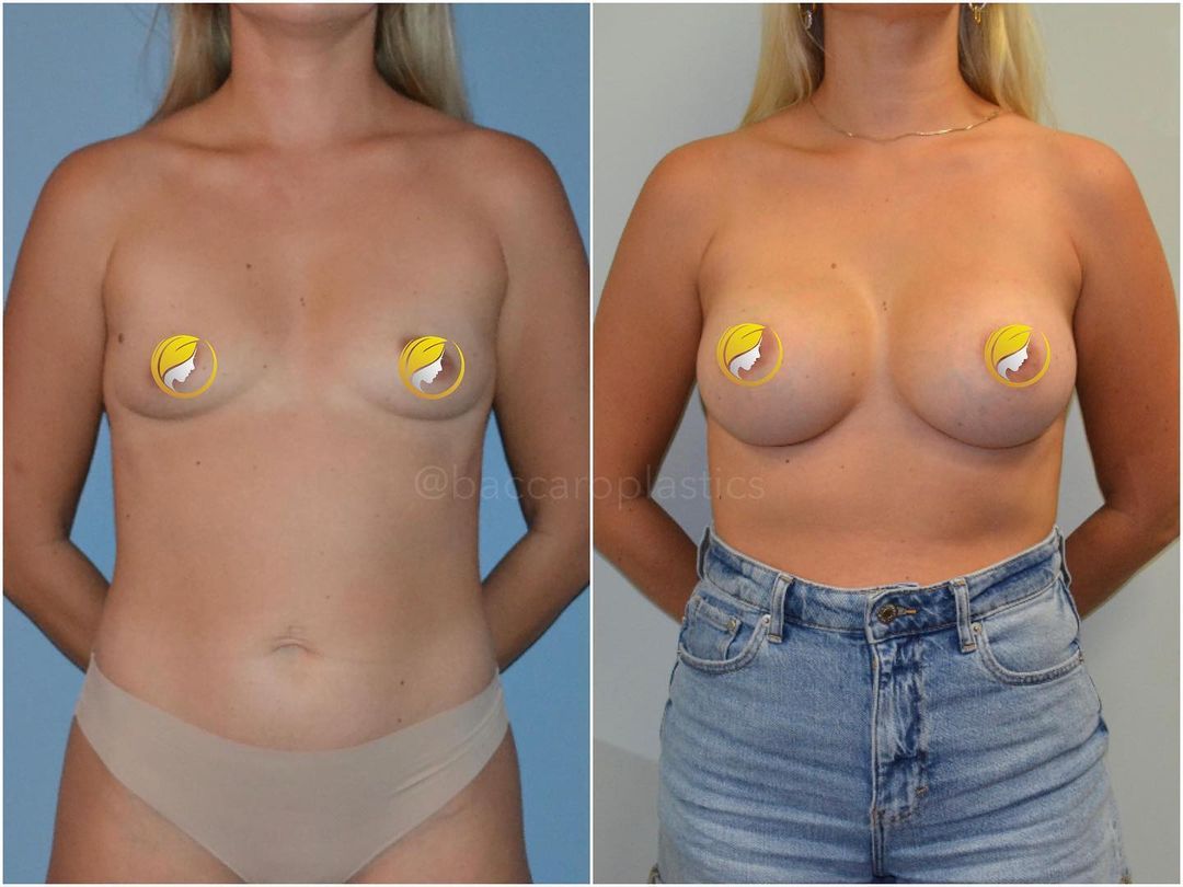Hybrid Breast Augmentation by Dr. Baccaro
