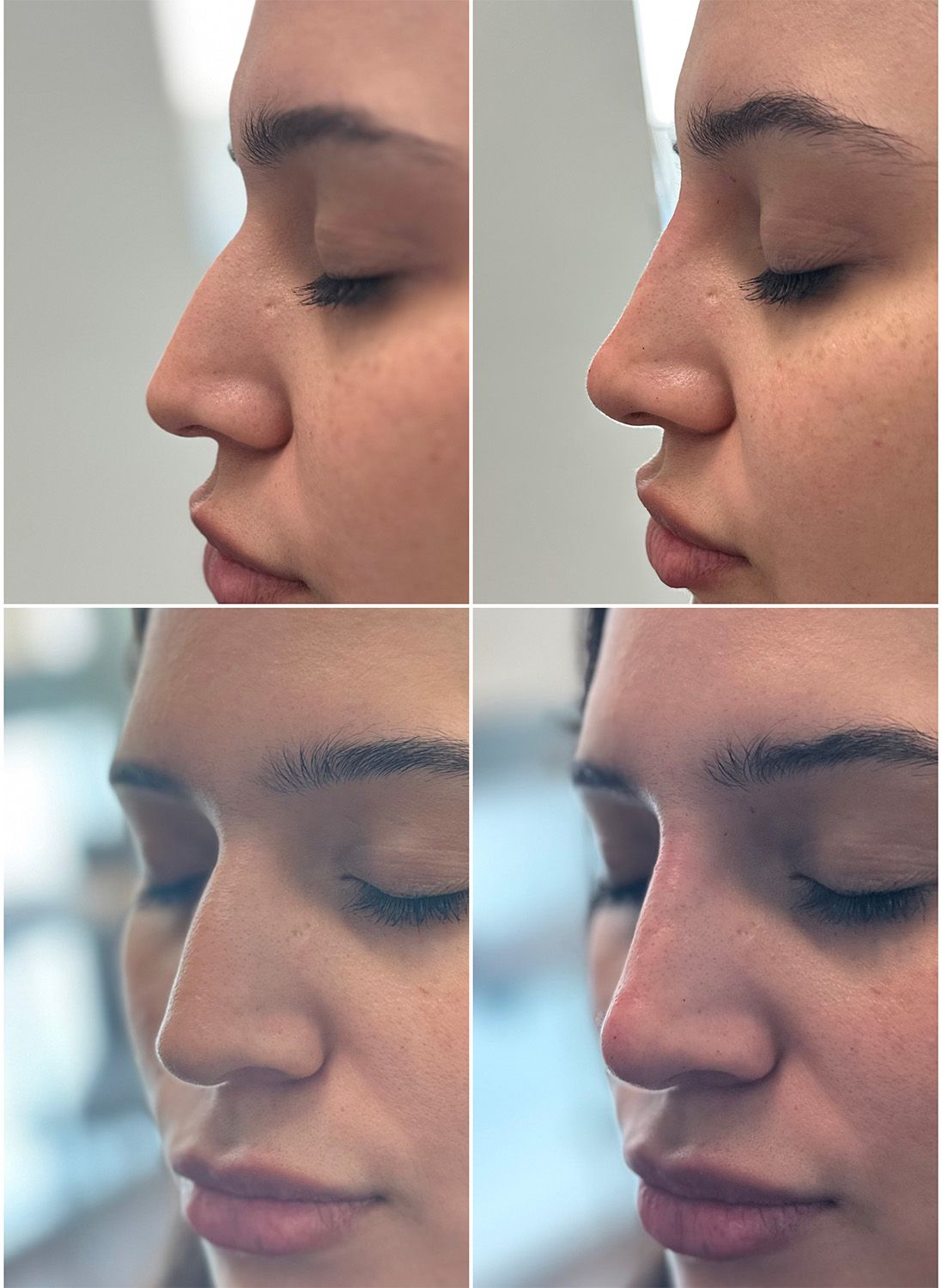 Liquid Rhinoplasty Performed by Dr. Baccaro
