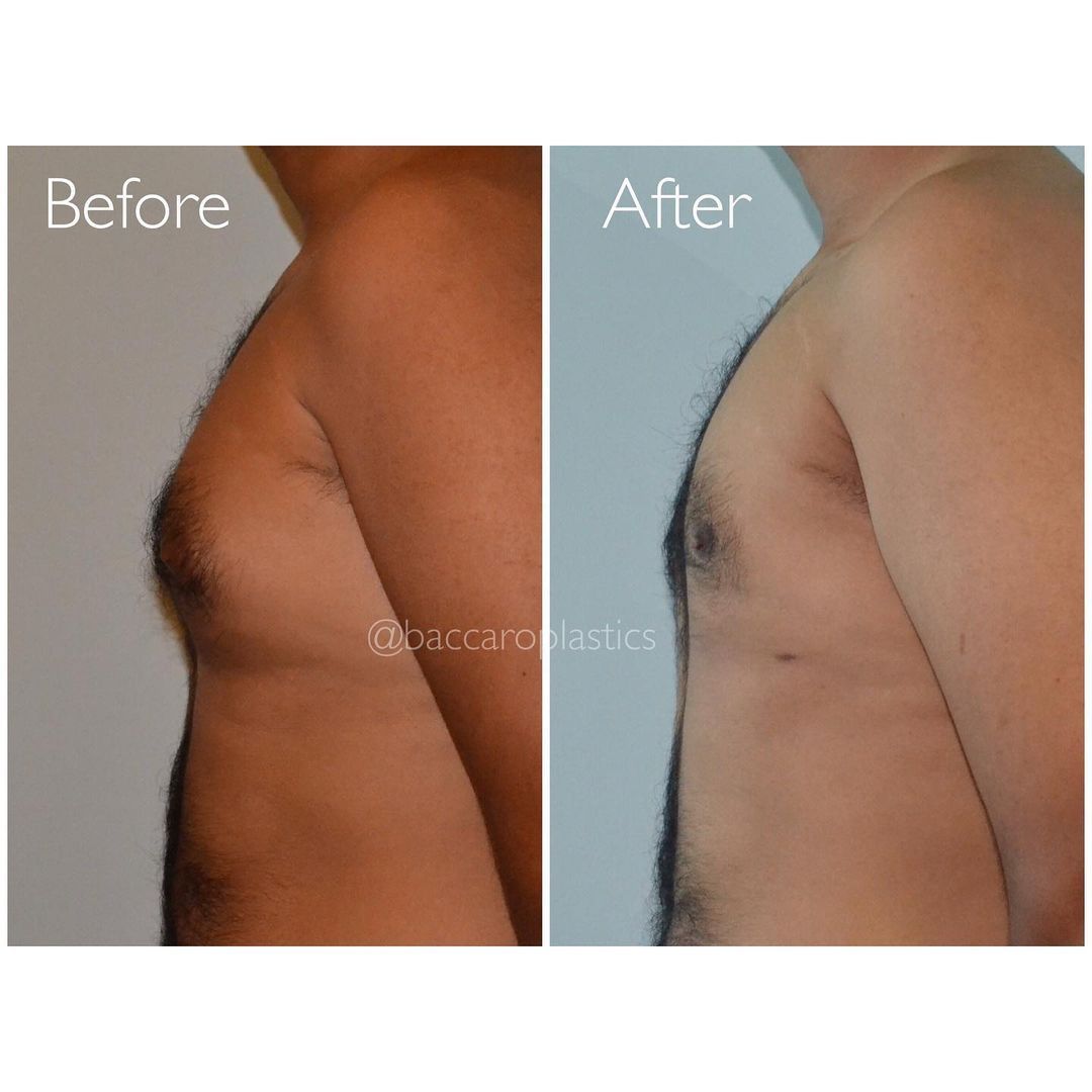 Gynecomastia Surgery by Dr. Baccaro