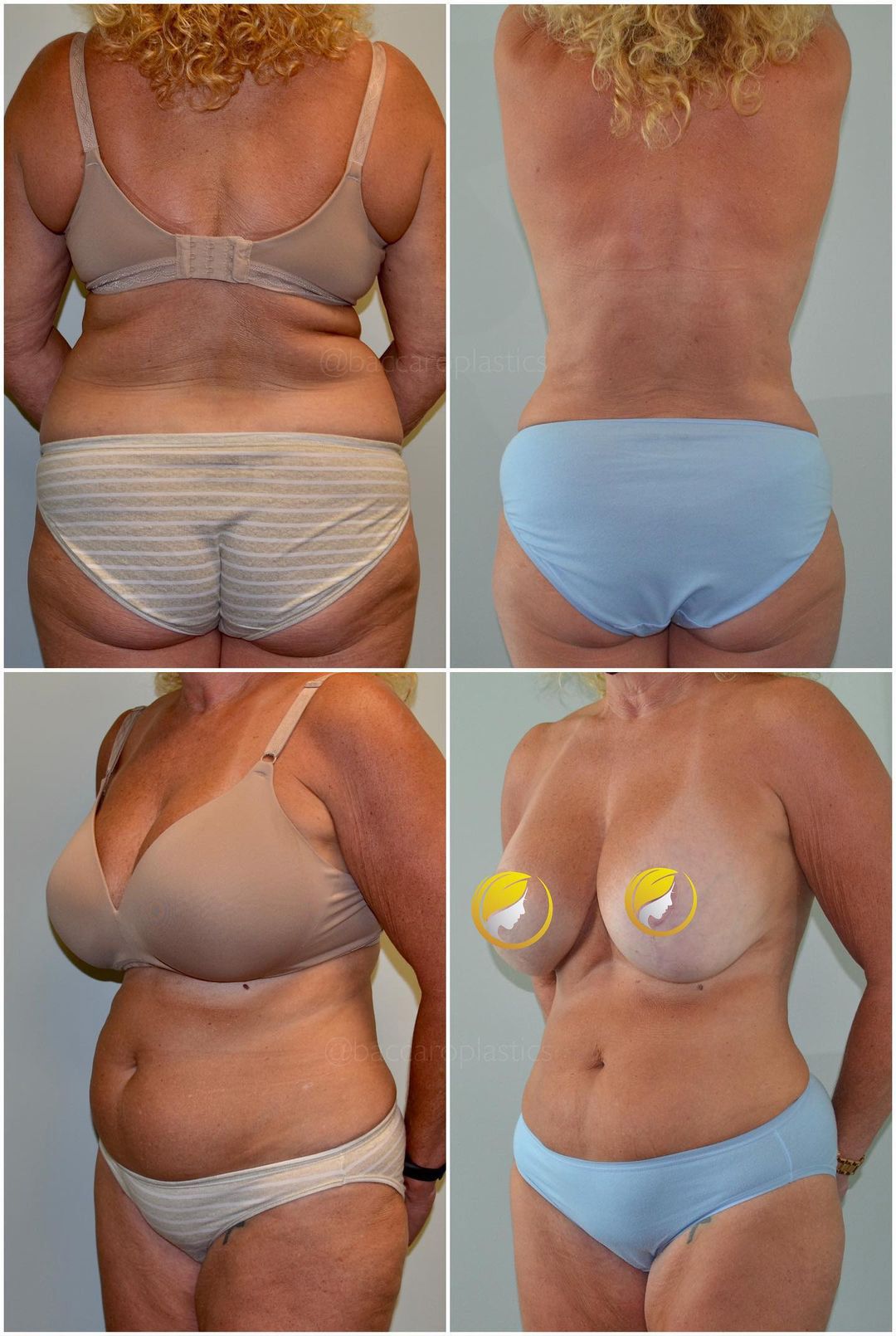 Liposuction by Dr. Leo Baccaro