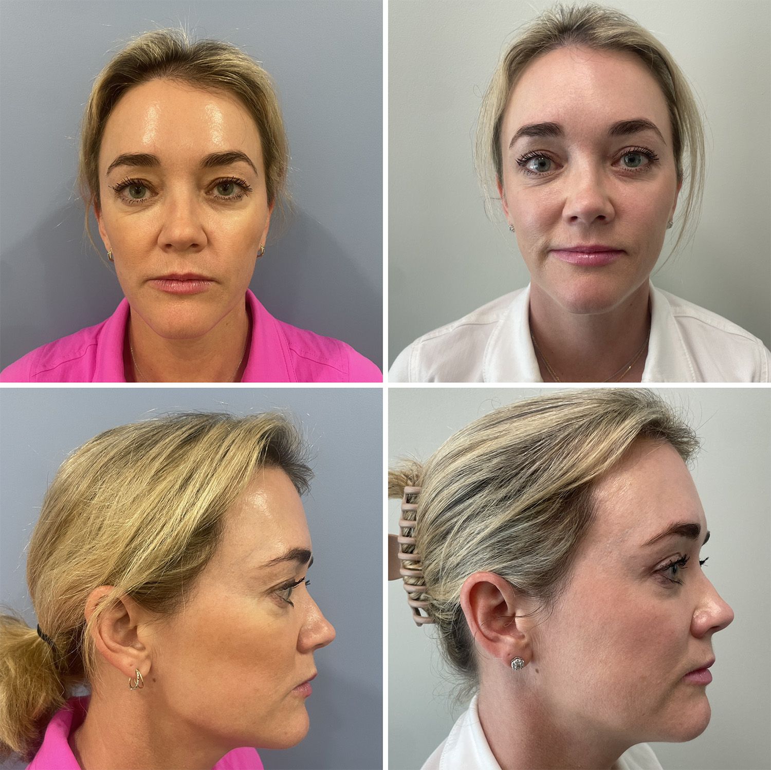Blepharoplasty Procedure performed by Dr. Walsh