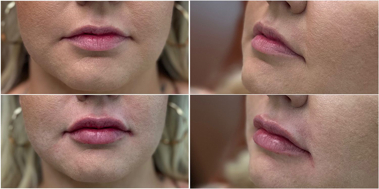Lip Filler by Dr. Baccaro