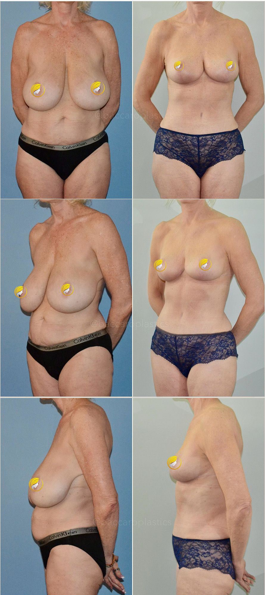 Mommy Makeover Performed by Dr. Baccaro
