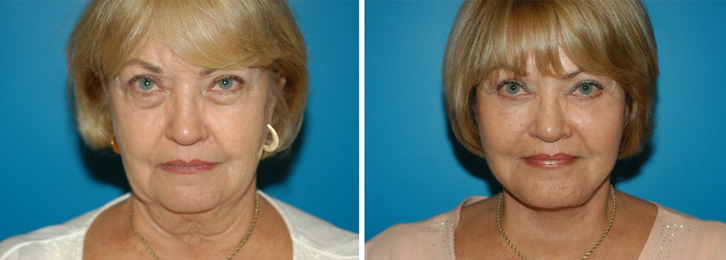 Face and Neck Lift with Lower Blepharoplasty