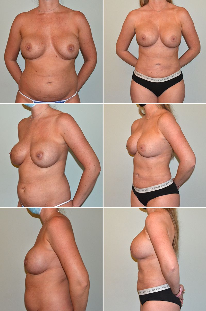 Implant Exchange by Dr. Baccaro