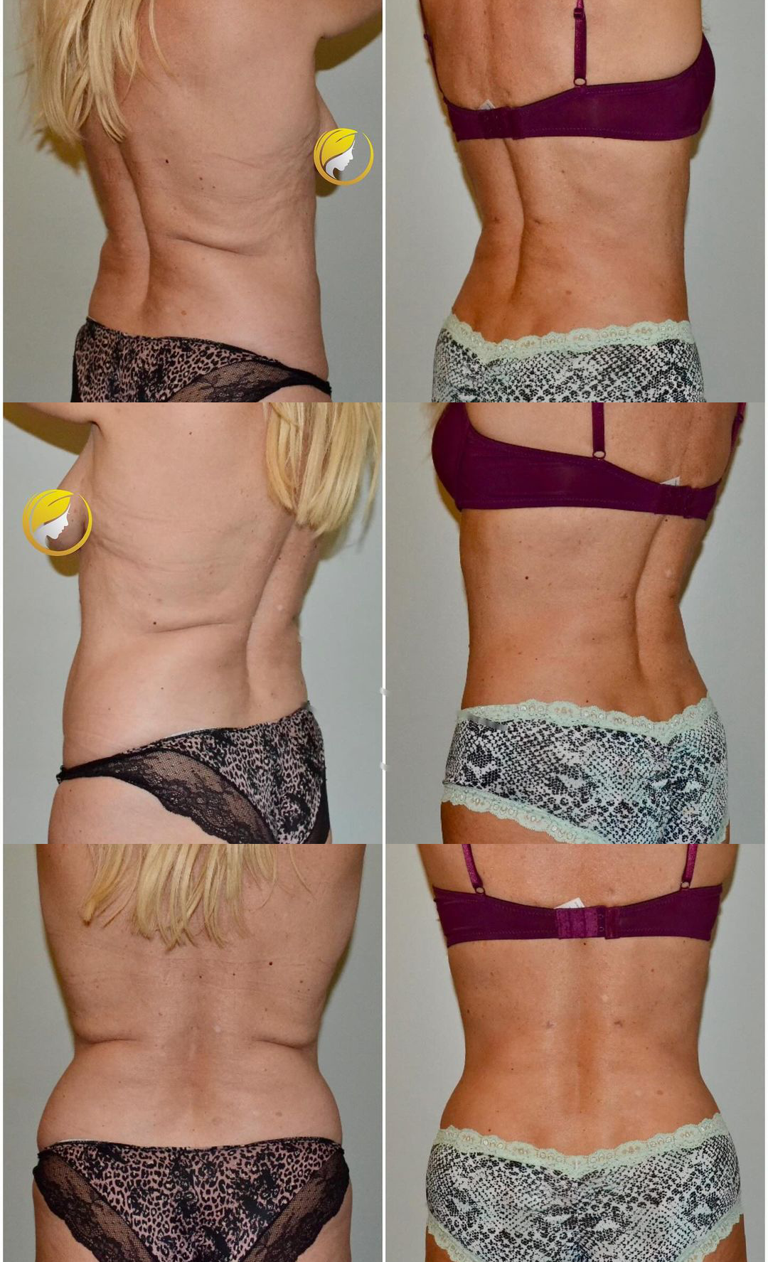 Before and After Plastic Surgery: Liposuction