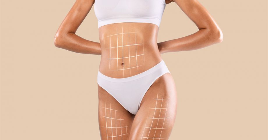 Benefits of Liposuction
