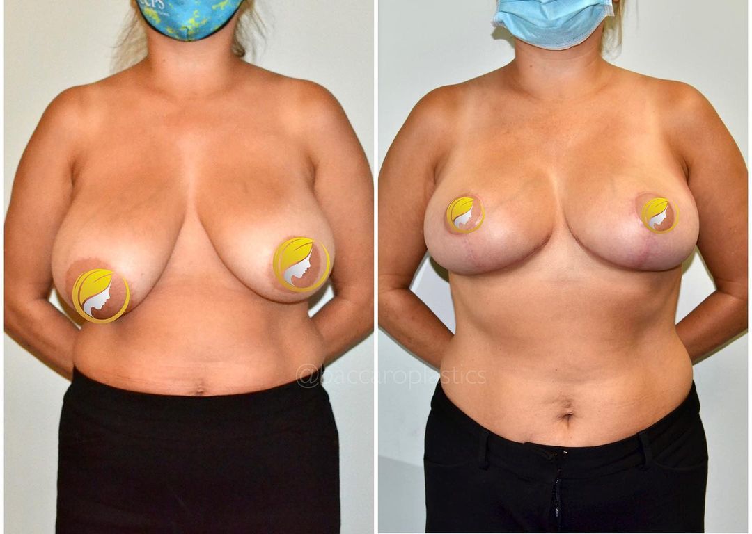 Breast Reduction and Lift by Dr. Baccaro