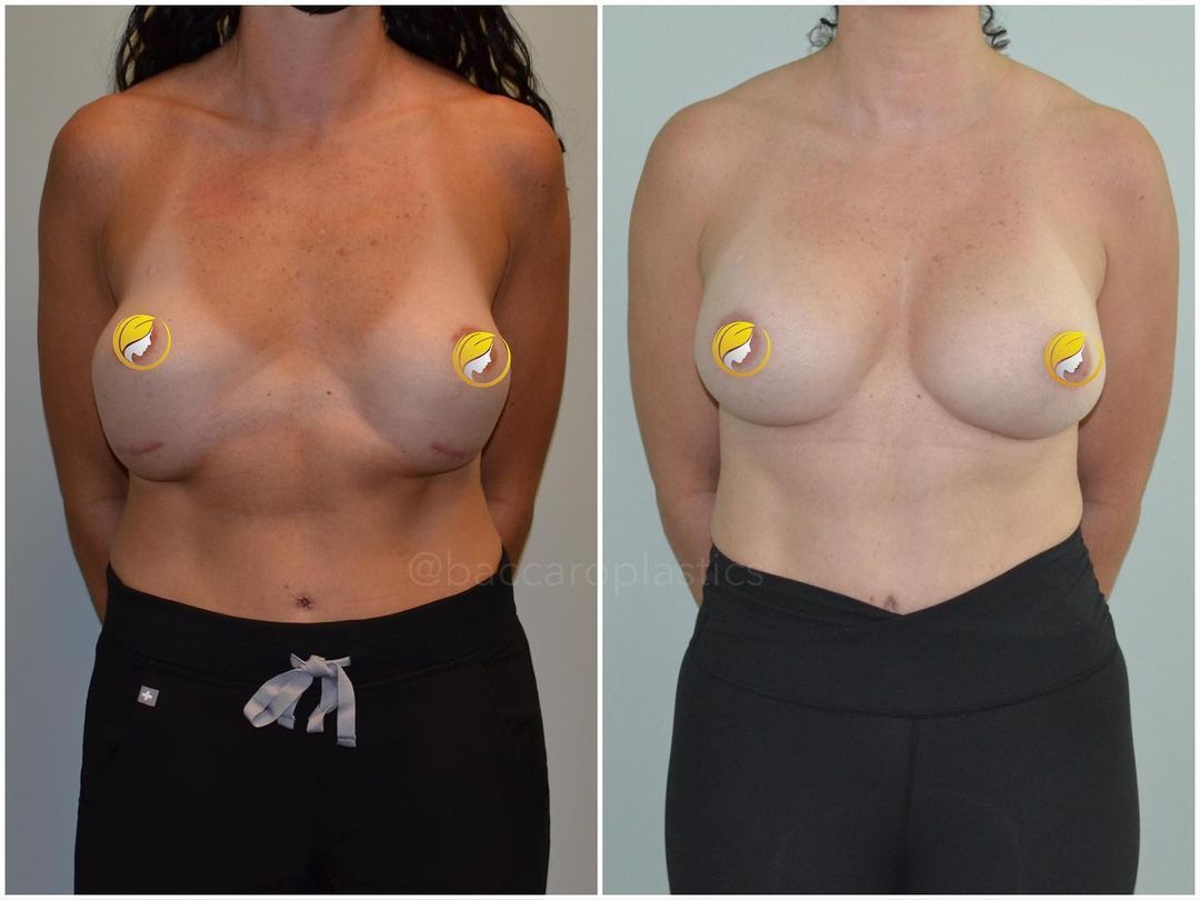 Complex Breast Revision by Dr. Baccaro