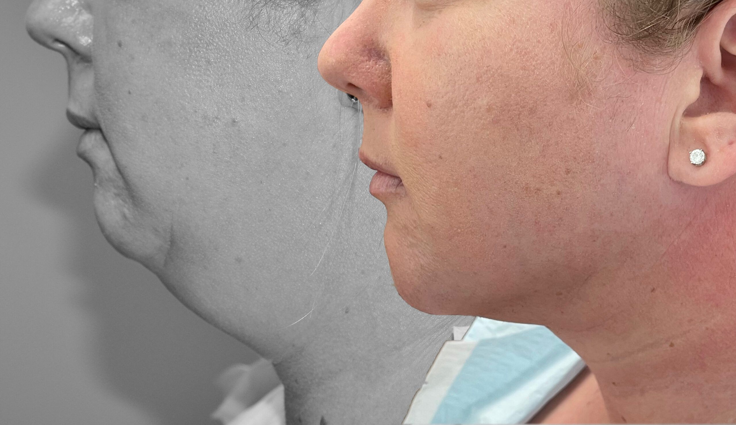 Neck Lipo with Skin Tightening by Dr. Baccaro