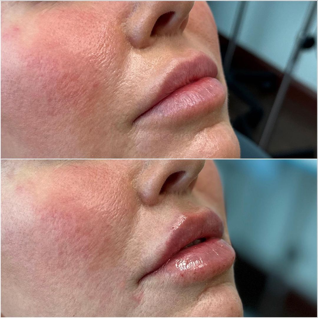 Lip Augmentation by Dr. Baccaro