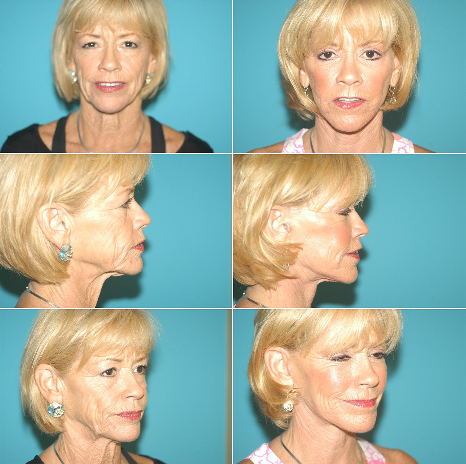 Facelift by Dr. Gardner