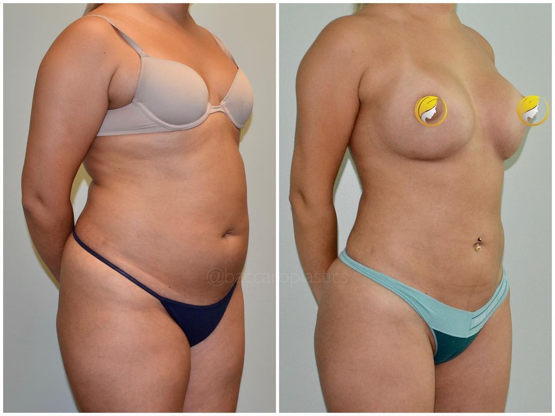 Hybrid Breast Augmentation by Dr. Baccaro