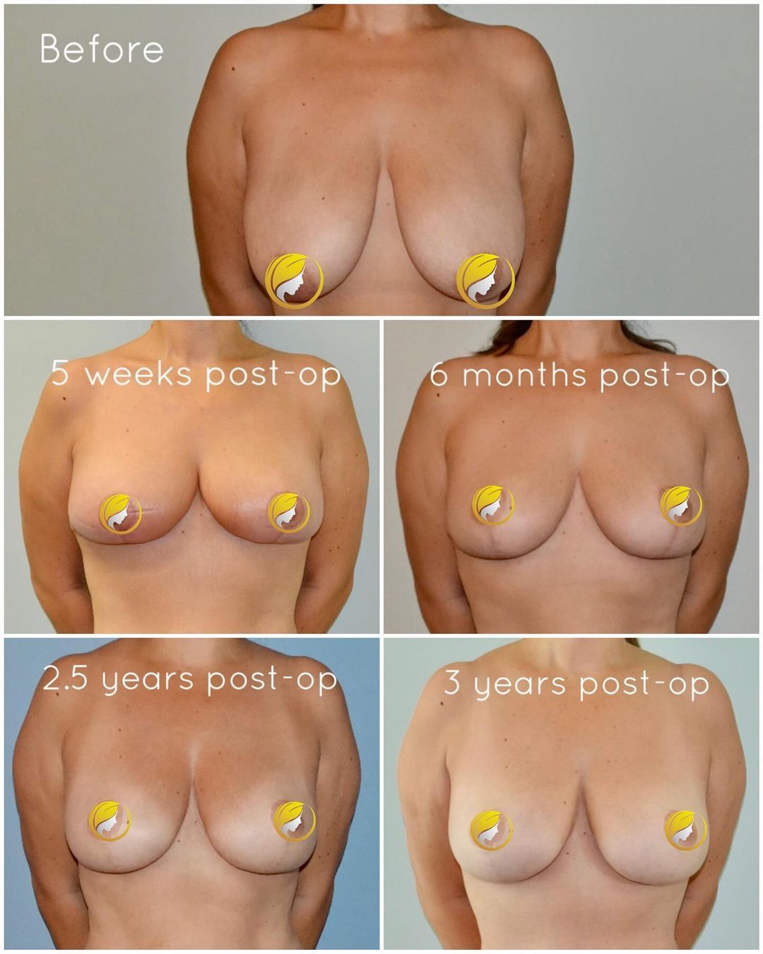 Breast Reduction by Dr. Baccaro