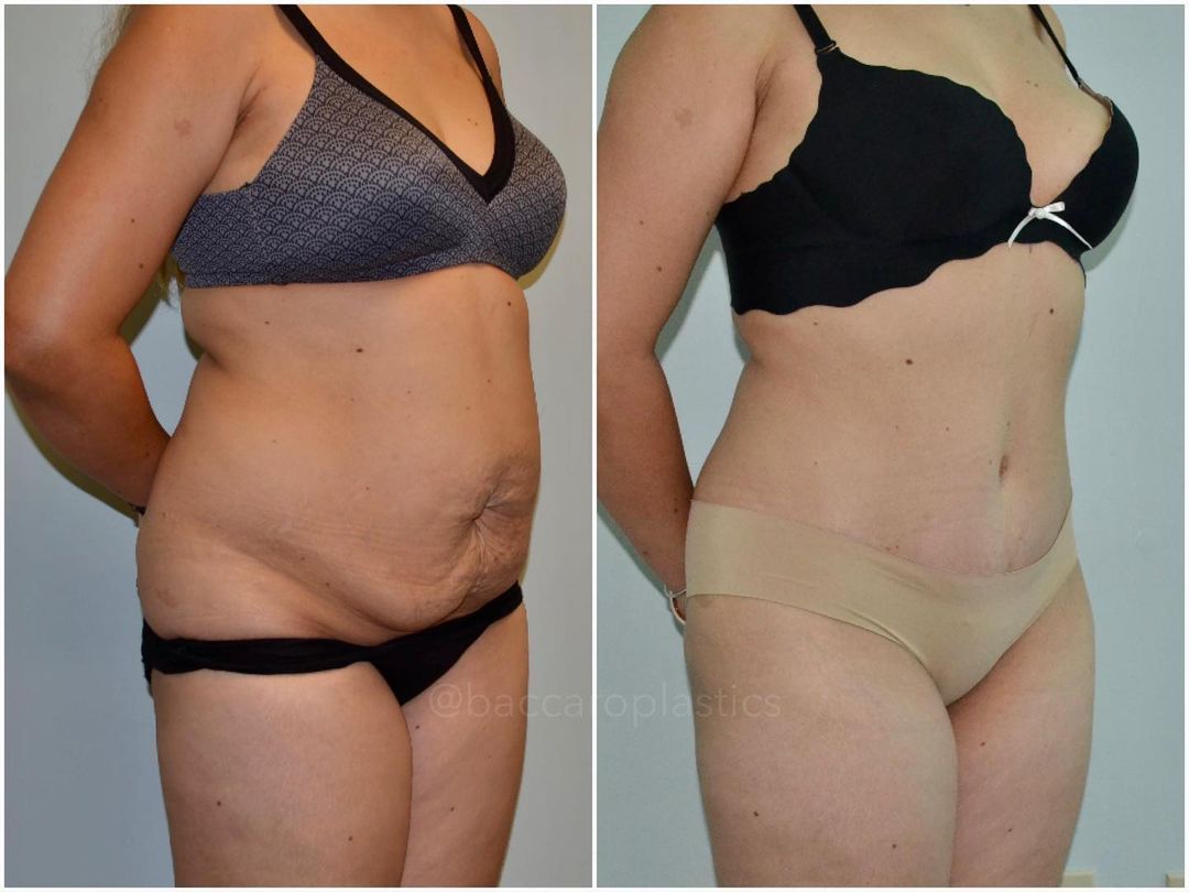 Tummy Tuck by Dr. Baccaro