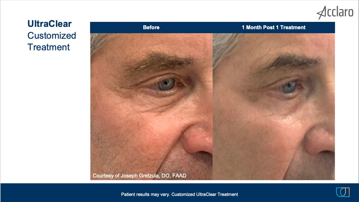 UltraClear Laser Performed by Joseph Gretzula