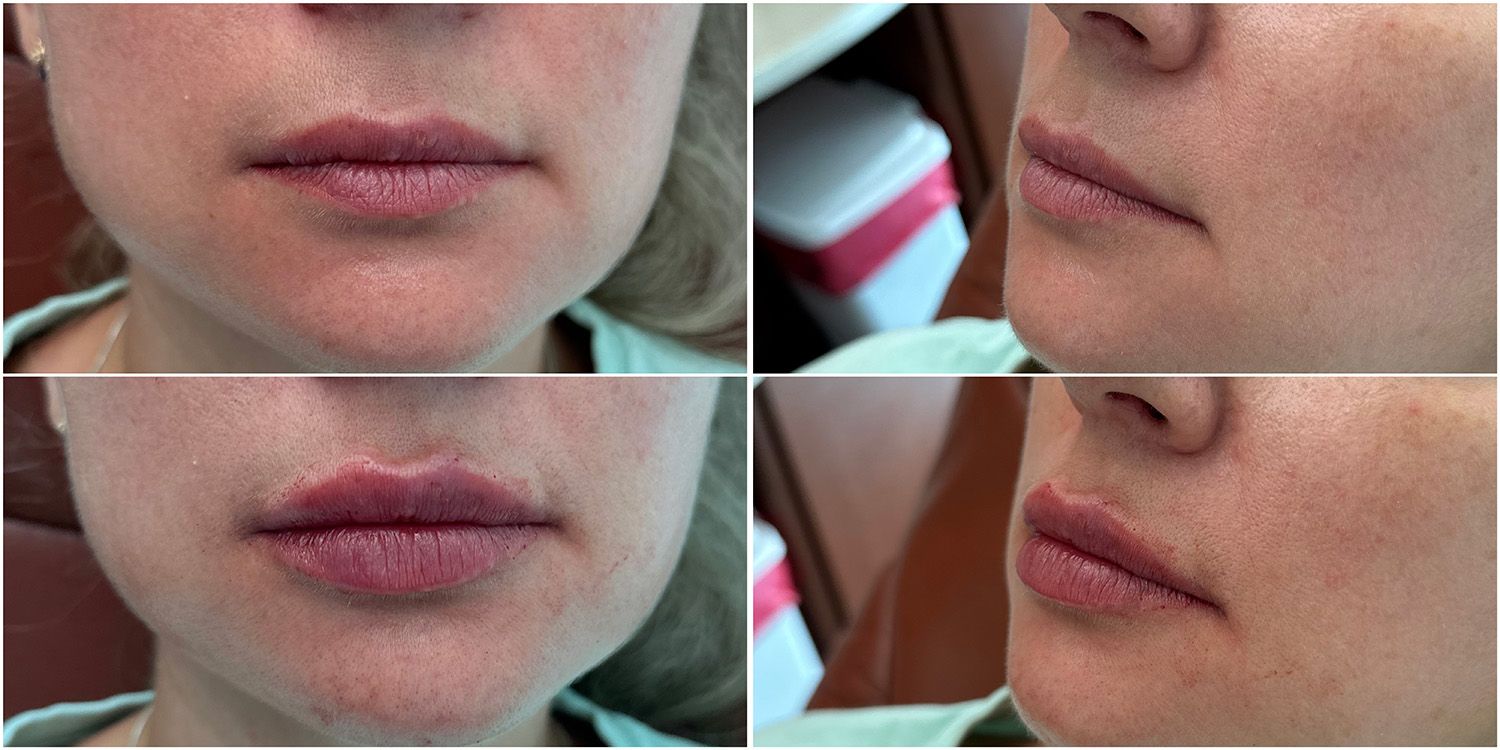 Lip Filler by Dr. Baccaro