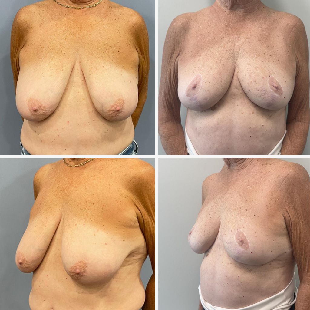 Breast Lift and Breast Reduction Performed by Dr. Bonett