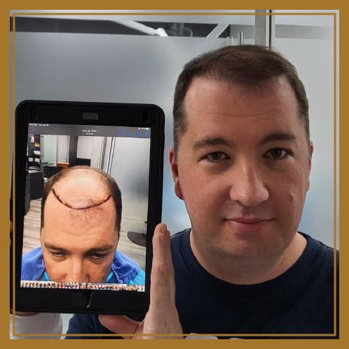 Before and after naples male hair restoration