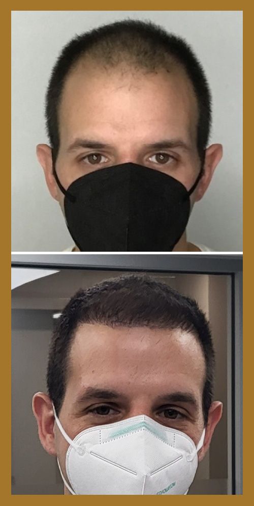 Hair Restoration by Dr. Wisiorek