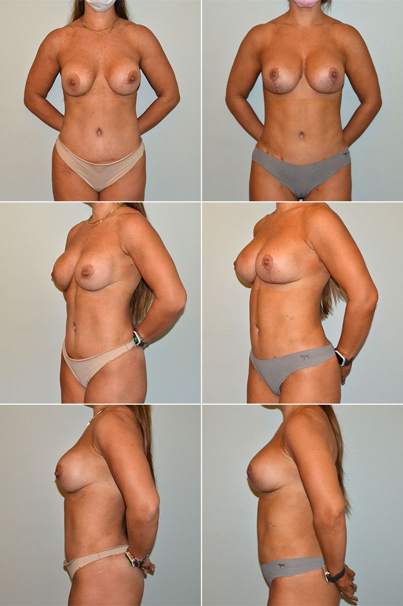 Breast Augmentation and Lift by Dr. Baccaro