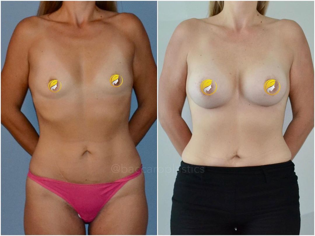 Hybrid Breast Augmentation by Dr. Baccaro