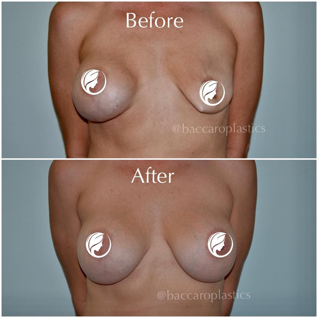 Breast Implant Rupture Fix by Dr. Baccaro
