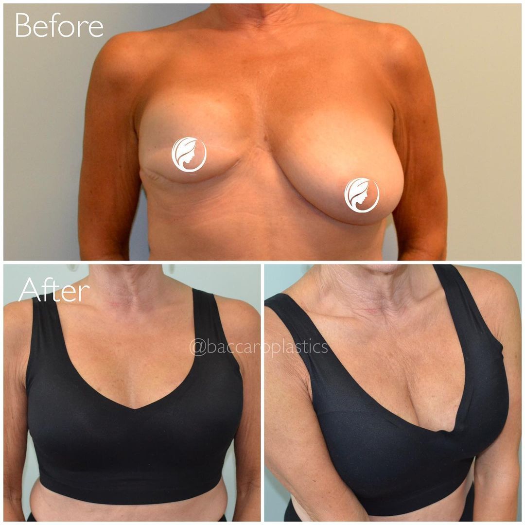 Breast Reconstruction by Dr. Baccaro
