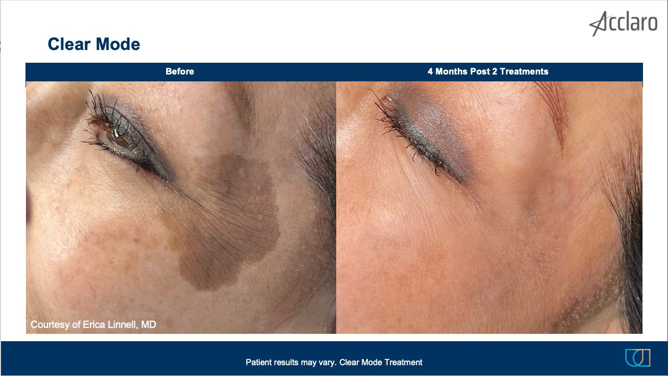 UltraClear Laser Performed by Erica Linnell