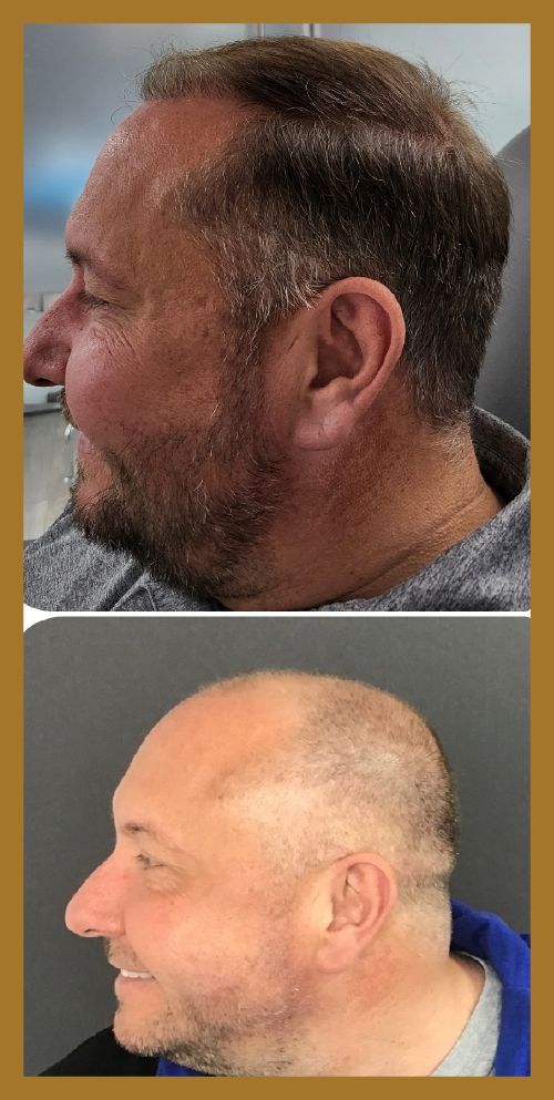 Happy male hair loss restoration patient