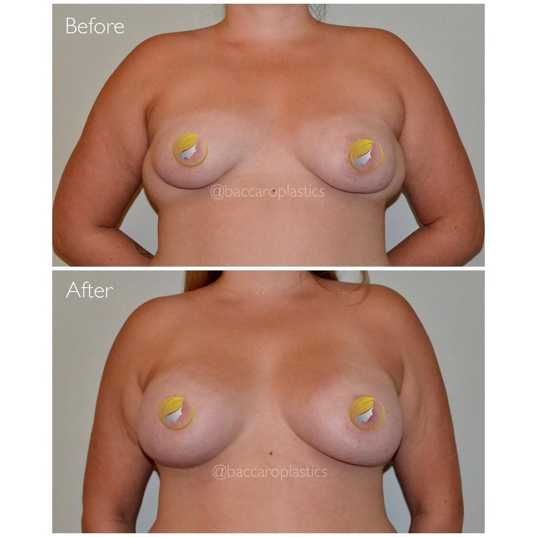 Breast Asymmetry Reconstruction by Dr. Baccaro