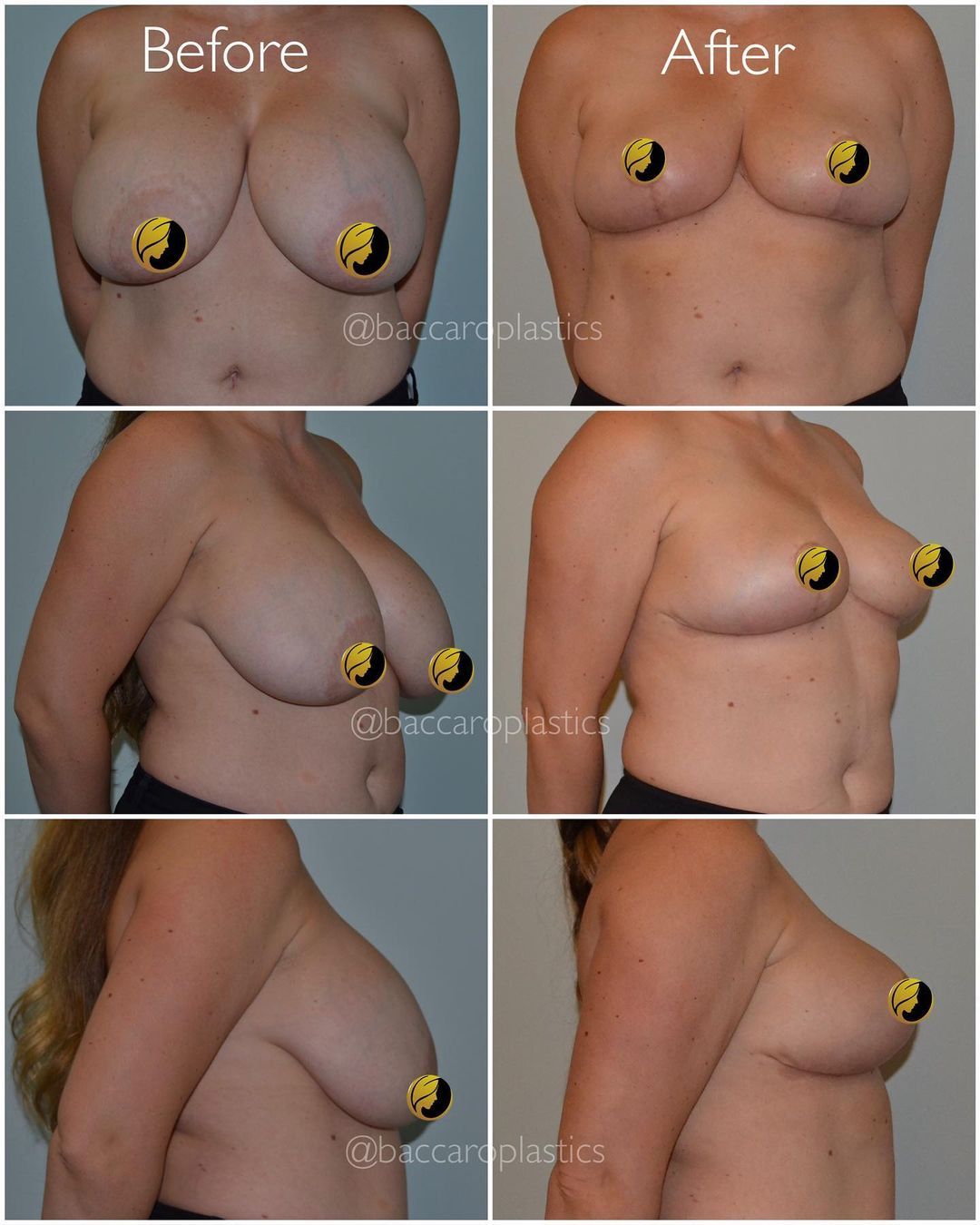Breast Reduction and Lift by Dr. Baccaro