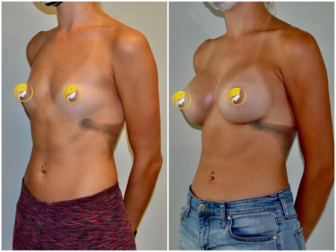 Hybrid Breast Augmentation by Dr. Baccaro