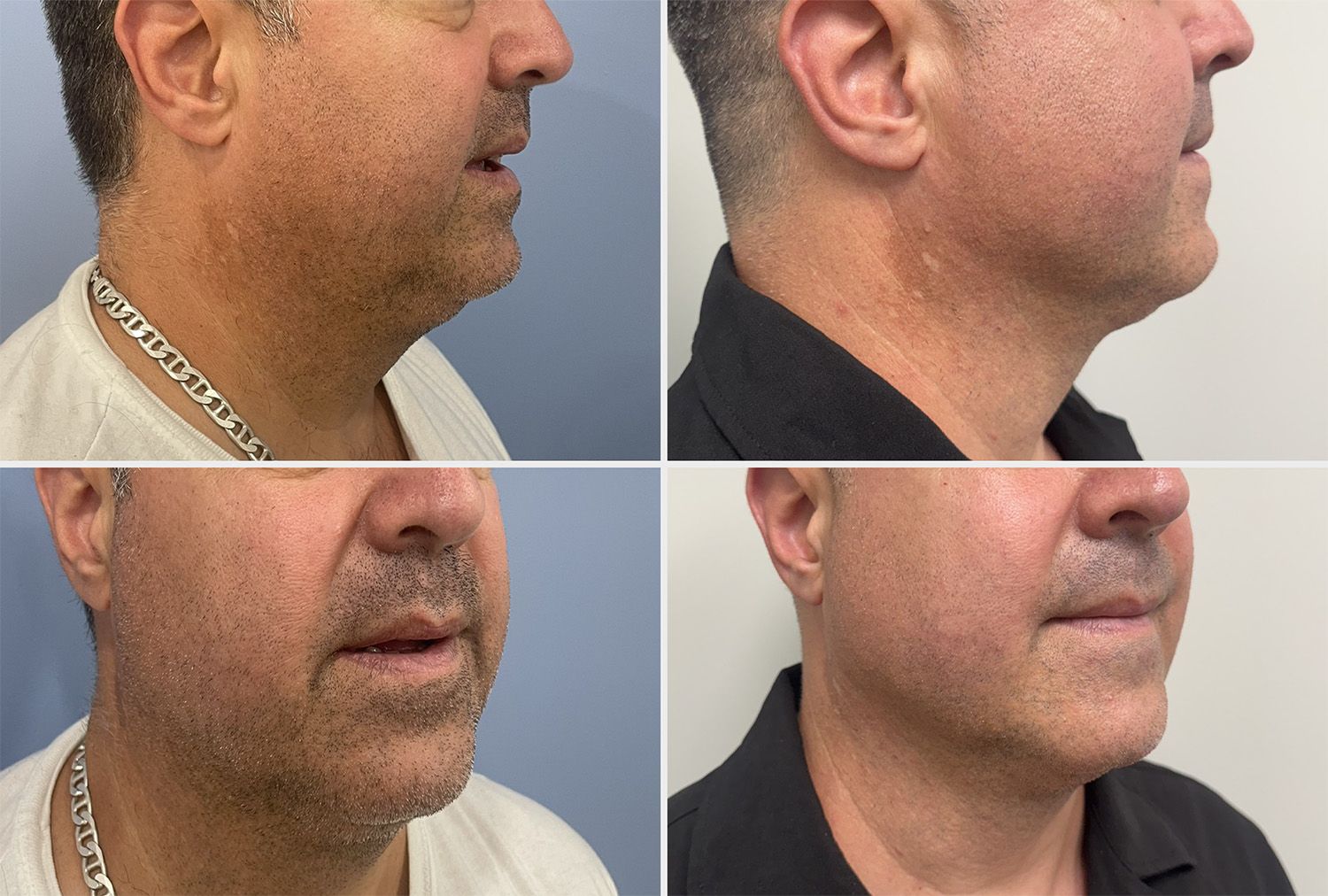 Neck Liposuction by Dr. Walsh