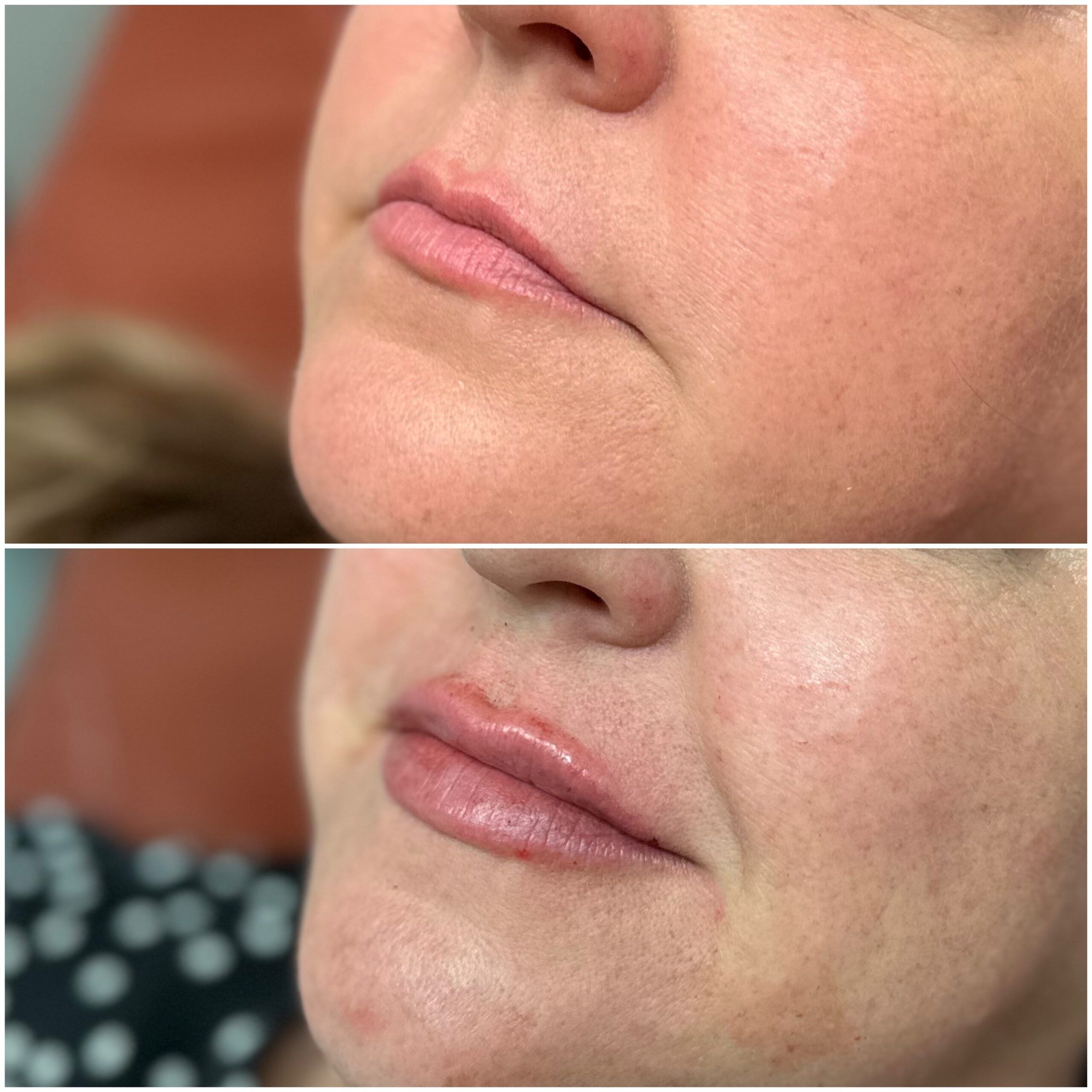 Lip Filler by Dr. Baccaro