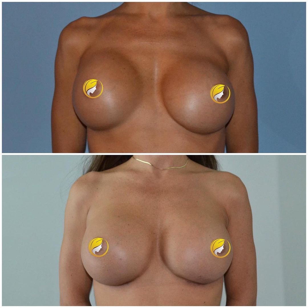 Implant Exchange by Dr. Baccaro