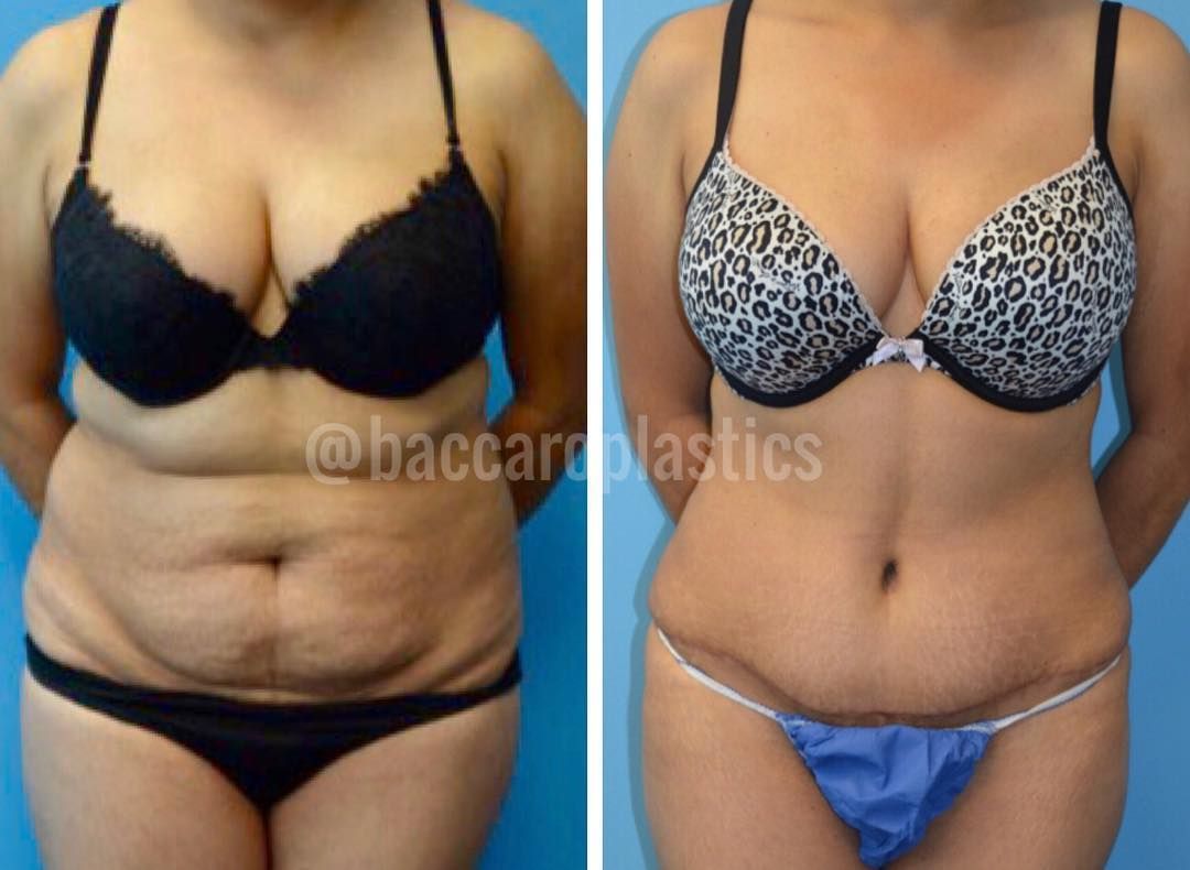 Tummy Tuck by Dr. Baccaro