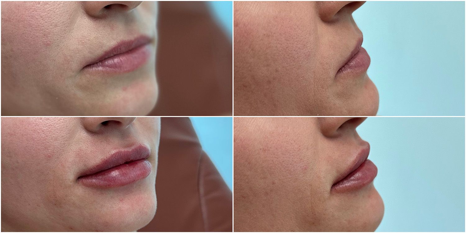 Lip Filler by Dr. Baccaro