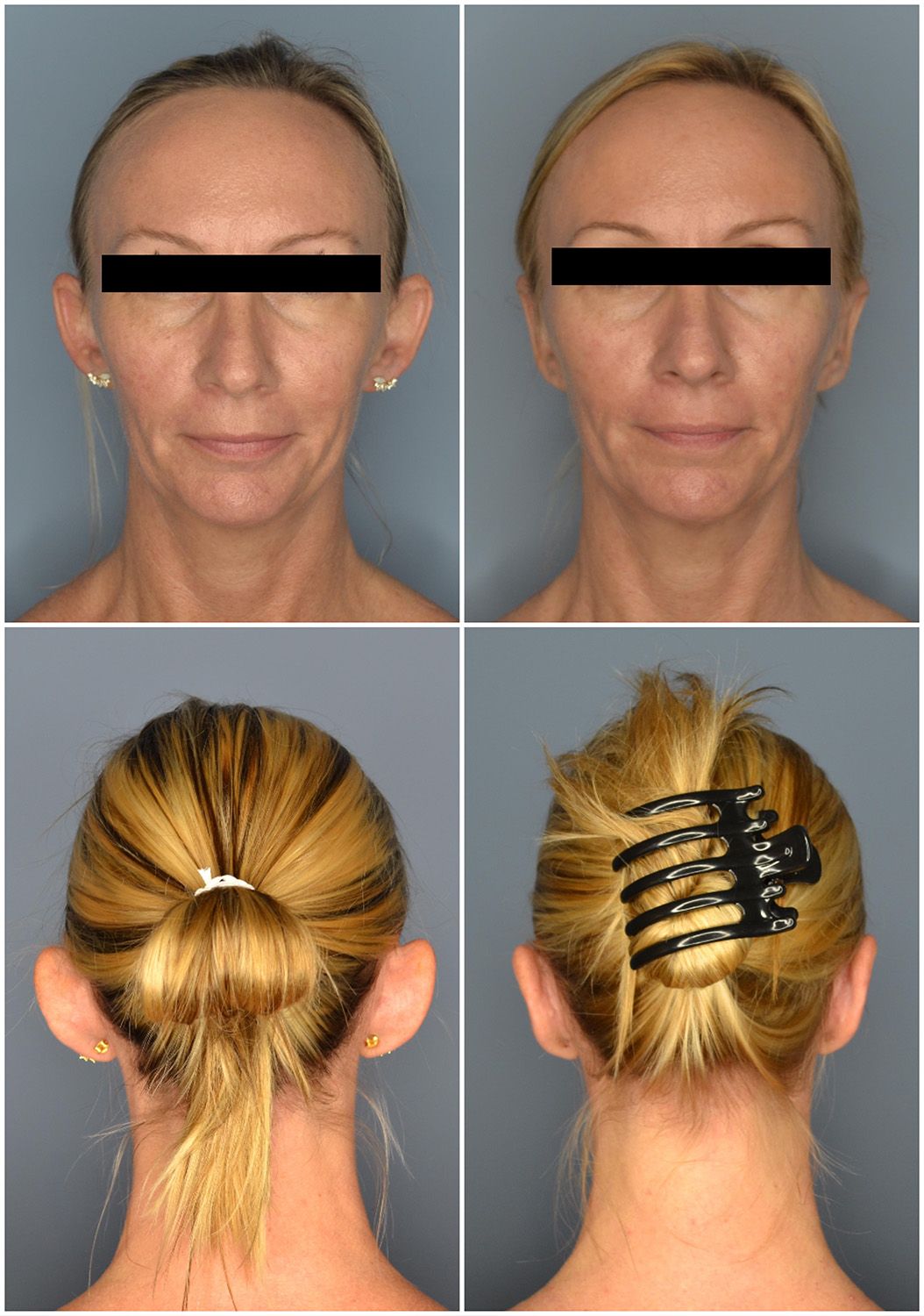 Otoplasty Performed by Dr. Baccaro