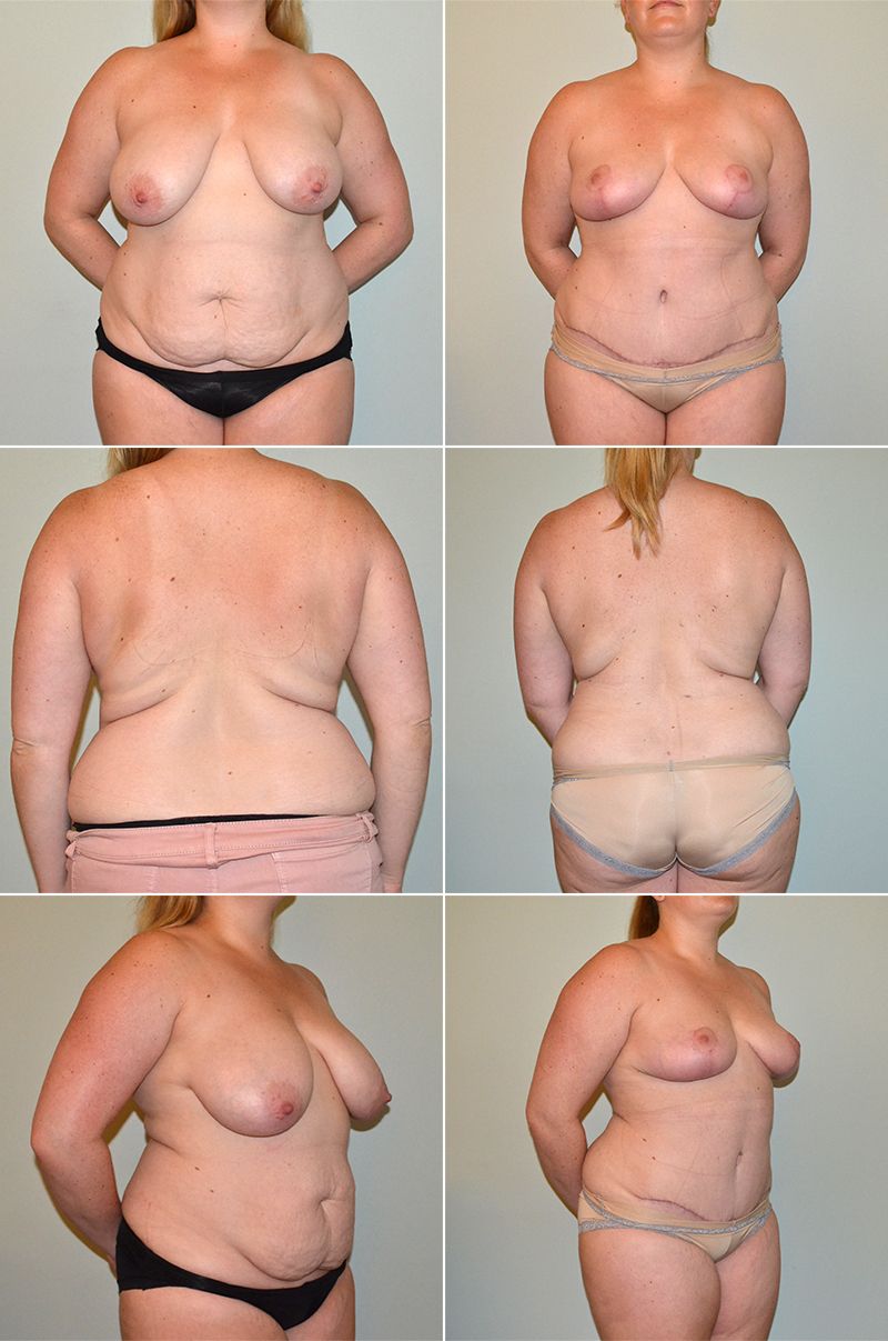 tummy tuck 12