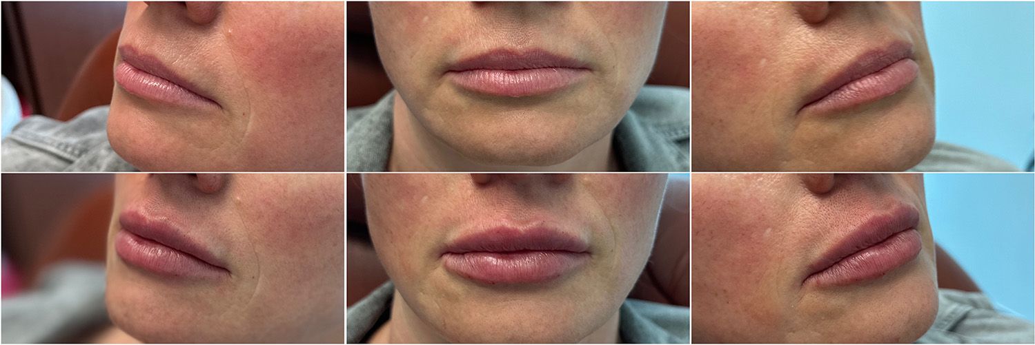 Lip Filler by Dr. Baccaro
