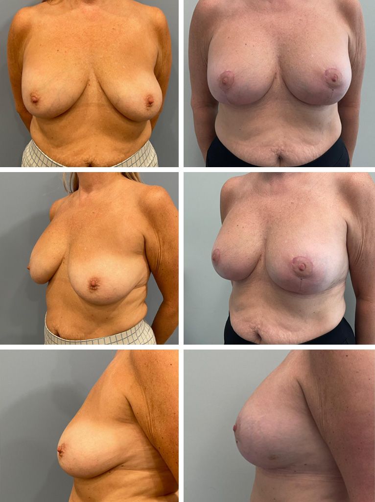 Breast Augmentation Performed by Dr. Bonett