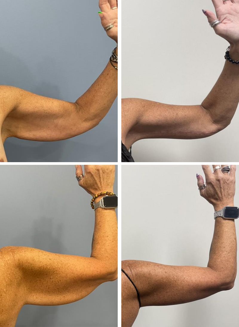 Arm Lift by Dr. Bonett