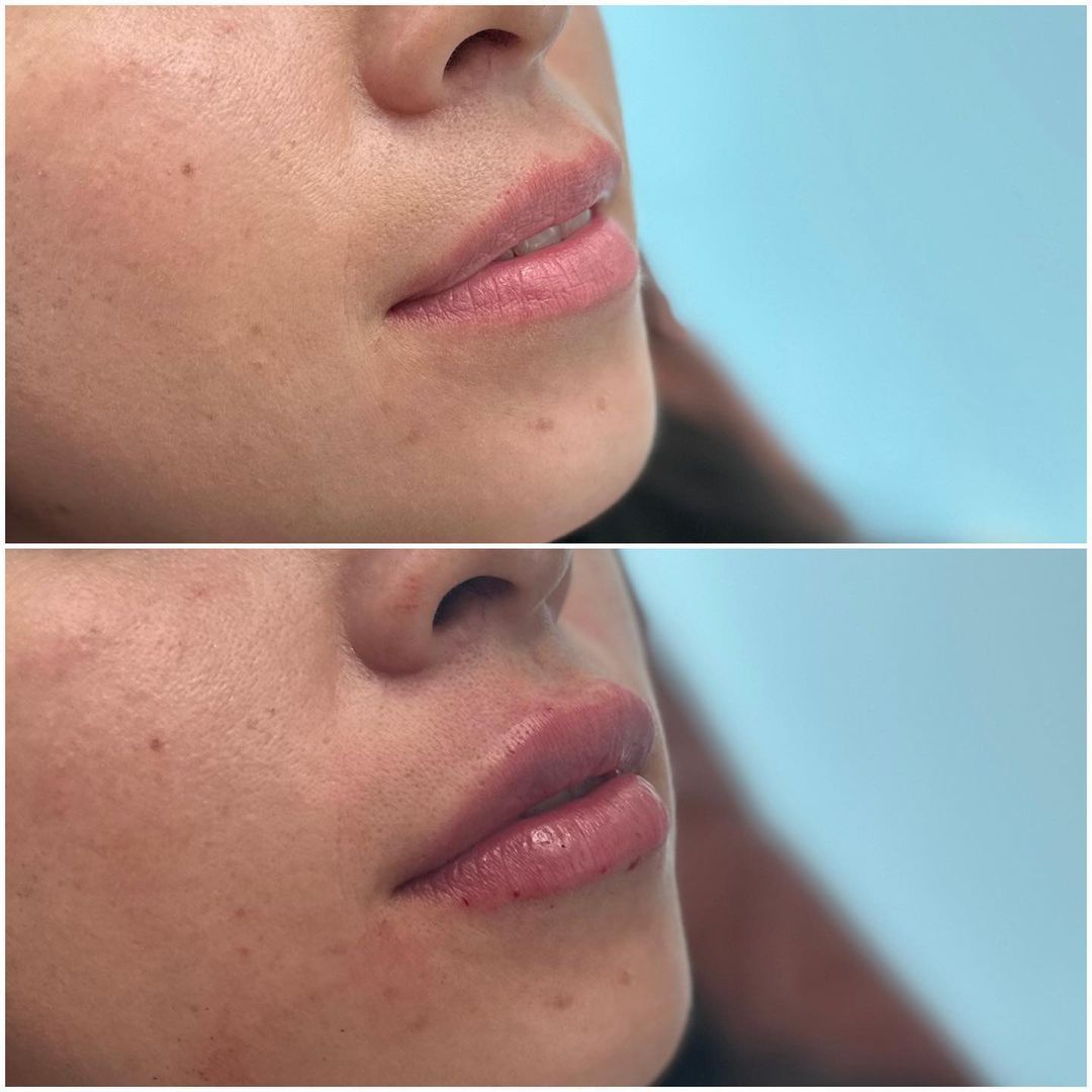 Lip Augmentation by Dr. Baccaro